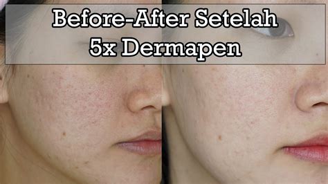 5 Alasan Harga Dermapen di ERHA Bikin Kantong Gemetar (Tapi Worth It!) 5 Alasan Harga Dermapen di ERHA Bikin Kantong Gemetar (Tapi Worth It!)