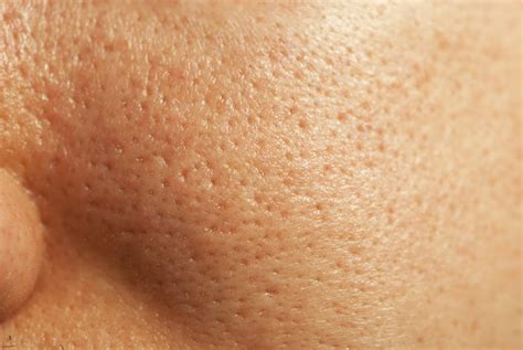 5 Alasan Laser Mengecilkan Pori-Pori Wajah Lebih Ampuh dari Skincare! 5 Alasan Laser Mengecilkan Pori-Pori Wajah Lebih Ampuh dari Skincare!