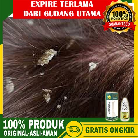 5 Cara Jitu Atasi Kulit Kepala Kering and Gatal dalam Seminggu!