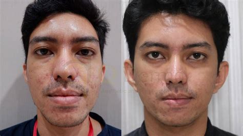 5 Harga Laser Wajah di Larissa yang Bikin Kamu Terkejut, Mulai dari Rp 500 Ribu! 5 Harga Laser Wajah di Larissa yang Bikin Kamu Terkejut, Mulai dari Rp 500 Ribu!
