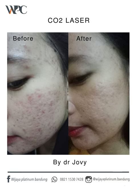 5 Rekomendasi Laser Wajah di Larissa, Mulai dari Rp500.000! 5 Rekomendasi Laser Wajah di Larissa, Mulai dari Rp500.000!