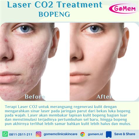 5 Rekomendasi Laser Wajah di Larissa, Mulai dari Rp500.000! 5 Rekomendasi Laser Wajah di Larissa, Mulai dari Rp500.000!