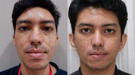5 Rekomendasi Laser Wajah di Larissa, Mulai dari Rp500.000! 5 Rekomendasi Laser Wajah di Larissa, Mulai dari Rp500.000!
