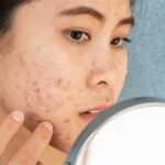 7 Cara Merawat Kulit Berjerawat dan Berminyak yang Ampuh dan Alami untuk Dicoba Sekarang!