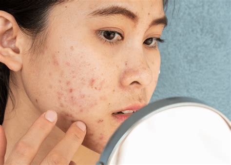 7 Cara Merawat Kulit Berjerawat dan Berminyak yang Ampuh dan Alami untuk Dicoba Sekarang!