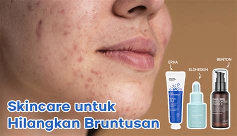 7 Jurus Ampuh Basmi Komedo Membandel, Wajah Mulus Seketika! 7 Jurus Ampuh Basmi Komedo Membandel, Wajah Mulus Seketika!