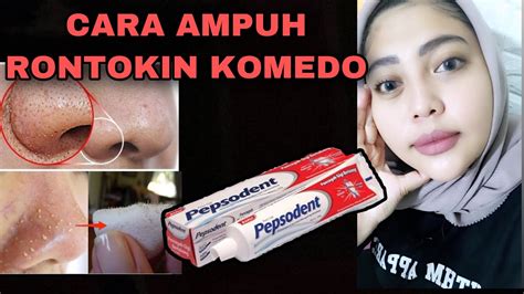 7 Jurus Ampuh Basmi Komedo Membandel, Wajah Mulus Seketika! 7 Jurus Ampuh Basmi Komedo Membandel, Wajah Mulus Seketika!