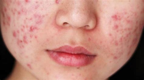 7 Langkah Bye-Bye Jerawat: Panduan Skincare Ampuh untuk Wajah Mulus! 7 Langkah Bye-Bye Jerawat: Panduan Skincare Ampuh untuk Wajah Mulus!