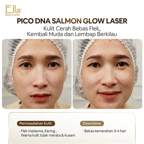 7 Rahasia Kulit Mulus Setelah Pico Laser: Bye-Bye Noda, Halo Glowing!