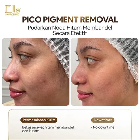 7 Rahasia Perawatan Pico Laser: Hasilnya Bikin Pangling! 7 Rahasia Perawatan Pico Laser: Hasilnya Bikin Pangling!