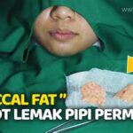 7 Treatment Mengecilkan Pipi Tembem, Hasilnya Bikin Pangling!