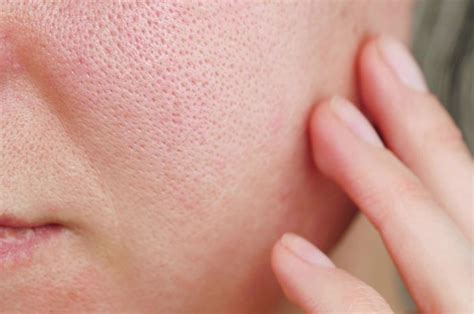 5 Cara Kilat Tutup Pori-Pori: Kulit Mulus Impian! 5 Cara Kilat Tutup Pori-Pori: Kulit Mulus Impian!