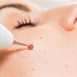 5 Mitos and Fakta Seputar Treatment Cauter Wajah yang Wajib Kamu Tahu!