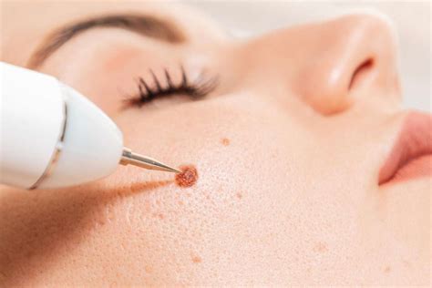 5 Mitos and Fakta Seputar Treatment Cauter Wajah yang Wajib Kamu Tahu! 5 Mitos and Fakta Seputar Treatment Cauter Wajah yang Wajib Kamu Tahu!