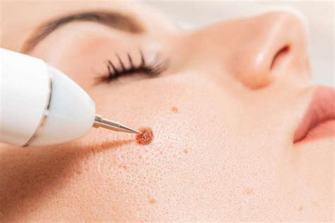 5 Mitos and Fakta Seputar Treatment Cauter Wajah yang Wajib Kamu Tahu!