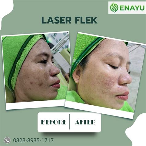 5 Pilihan Laser Wajah Larissa: Harga Mulai 99 Ribu, Bikin Glowing Instan! 5 Pilihan Laser Wajah Larissa: Harga Mulai 99 Ribu, Bikin Glowing Instan!