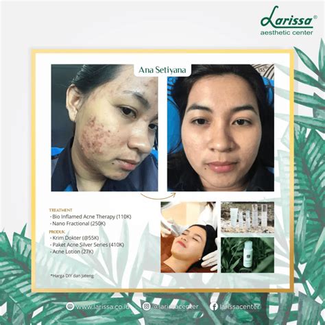 5 Pilihan Laser Wajah Larissa: Harga Mulai 99 Ribu, Bikin Glowing Instan! 5 Pilihan Laser Wajah Larissa: Harga Mulai 99 Ribu, Bikin Glowing Instan!