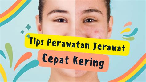 5 Rahasia Alami Atasi Wajah Sensitif and Berjerawat! 5 Rahasia Alami Atasi Wajah Sensitif and Berjerawat!