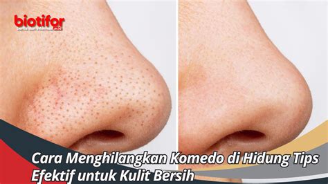 5 Treatment Komedo MENGAKTIFKAN Gluta and SKIN GLOW SPESIALIST Approved! 5 Treatment Komedo MENGAKTIFKAN Gluta and SKIN GLOW SPESIALIST Approved!
