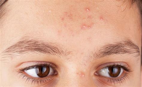 5 Treatment Wajah Anti-Jerawat Remaja yang Bikin Kulit Cerah Berkilau! 💫