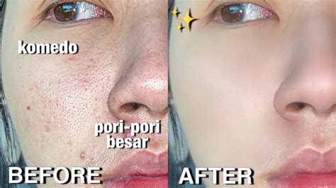 7 Cara Ampuh Mengecilkan Pori-Pori Wajah Secara Alami, Hasilnya Terlihat! 7 Cara Ampuh Mengecilkan Pori-Pori Wajah Secara Alami, Hasilnya Terlihat!