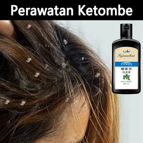 7 Cara Ampuh Menghilangkan Kulit Kepala Gatal yang Bisa Kamu Coba Hari Ini! 7 Cara Ampuh Menghilangkan Kulit Kepala Gatal yang Bisa Kamu Coba Hari Ini!