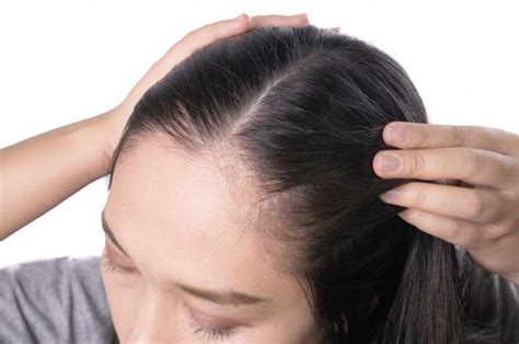 7 Cara Ampuh Menghilangkan Kulit Kepala Gatal yang Bisa Kamu Coba Hari Ini! 7 Cara Ampuh Menghilangkan Kulit Kepala Gatal yang Bisa Kamu Coba Hari Ini!