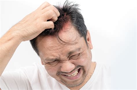 7 Cara Ampuh Menghilangkan Kulit Kepala Gatal yang Bisa Kamu Coba Hari Ini! 7 Cara Ampuh Menghilangkan Kulit Kepala Gatal yang Bisa Kamu Coba Hari Ini!