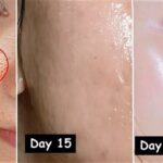 7 Cara Laser Mengecilkan Pori-Pori Wajah secara Instan dan Permanen!