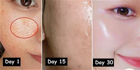 7 Cara Laser Mengecilkan Pori-Pori Wajah secara Instan dan Permanen! 7 Cara Laser Mengecilkan Pori-Pori Wajah secara Instan dan Permanen!