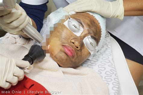 7 Fakta Biaya Laser Muka 2024: Lebih Murah dari Dugaan! 7 Fakta Biaya Laser Muka 2024: Lebih Murah dari Dugaan!