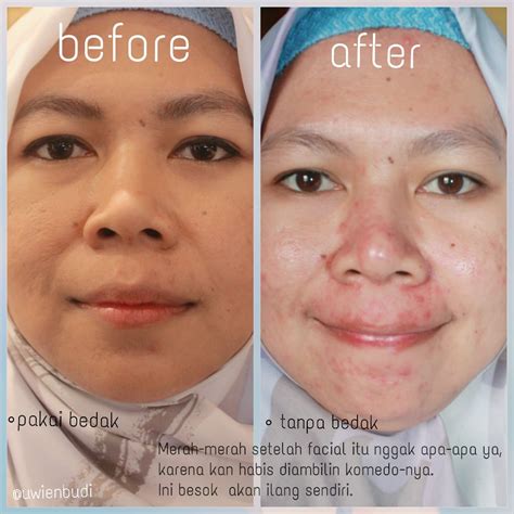 7 Fakta Mengejutkan Harga Dermapen di ERHA: Nomor 5 Bikin Dompet Kaget! 7 Fakta Mengejutkan Harga Dermapen di ERHA: Nomor 5 Bikin Dompet Kaget!