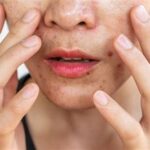 7 Langkah Bye-Bye Kulit Berminyak, Kusam, dan Jerawat!SkincareAntiKucel