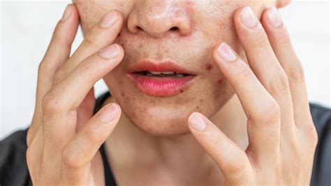 7 Langkah Bye-Bye Kulit Berminyak, Kusam, dan Jerawat!SkincareAntiKucel