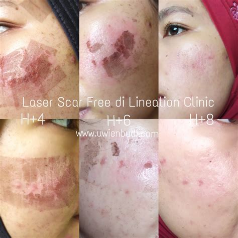 7 Manfaat Laser Wajah yang Belum Kamu Ketahui untuk Mendapatkan Kulit Mulus dan Bebas Jerawat! 7 Manfaat Laser Wajah yang Belum Kamu Ketahui untuk Mendapatkan Kulit Mulus dan Bebas Jerawat!