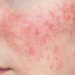 7 Rahasia Kulit Sensitif Bebas Iritasi: Cewek Wajib Tahu!