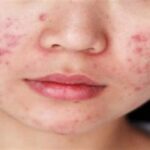 7 Rahasia Wajah Mulus Bebas Jerawat: Cara Alami yang Terbukti Ampuh!