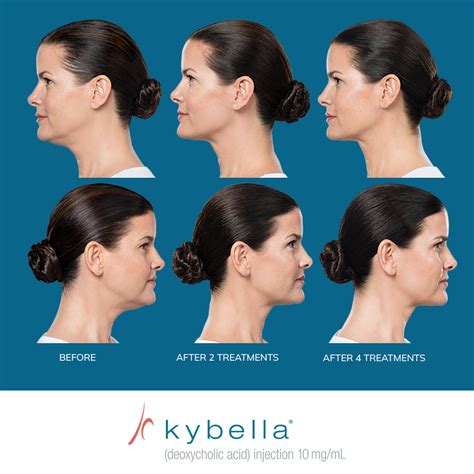 7 Treatment Mengecilkan Pipi Tembem, Langsung Tirus! 7 Treatment Mengecilkan Pipi Tembem, Langsung Tirus!
