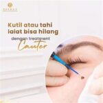 7 Treatment Cauter Wajah untuk Menghilangkan Jerawat dan Menciptakan Kulit Mulus dalam 1 Minggu!
