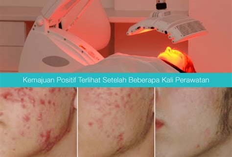 7 Treatment Cauter Wajah untuk Menghilangkan Jerawat dan Menciptakan Kulit Mulus dalam 1 Minggu! 7 Treatment Cauter Wajah untuk Menghilangkan Jerawat dan Menciptakan Kulit Mulus dalam 1 Minggu!